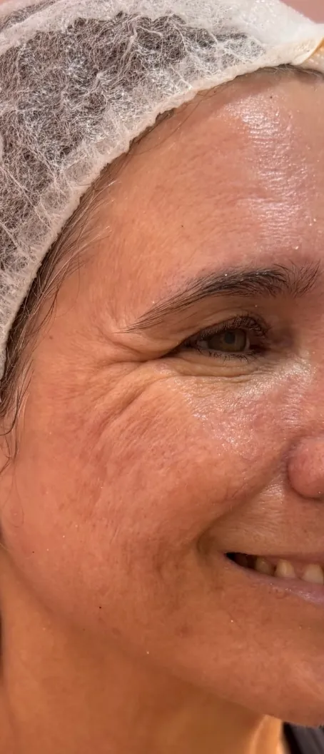 Botox: Pés de galinha · sorriso ativo (antes)