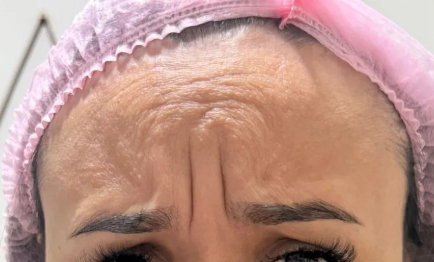 Botox: Testa e glabela · o “11” (antes)