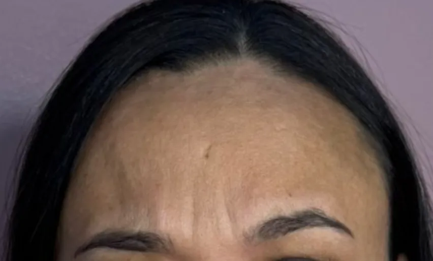 Botox: Testa e glabela · o “11” (depois)