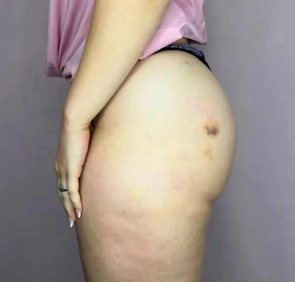 Criomodelagem: Contorno corporal feminino (depois)