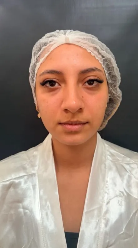 Harmonização facial: Frontal · harmonização completa (antes)