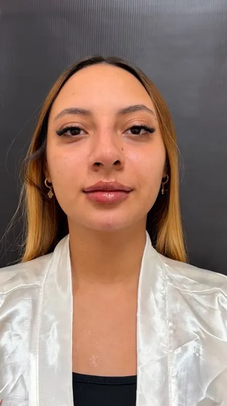 Harmonização facial: Frontal · harmonização completa (depois)