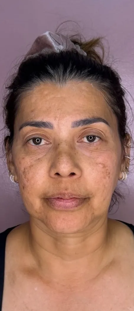 Harmonização facial: Frontal · terço inferior (antes)