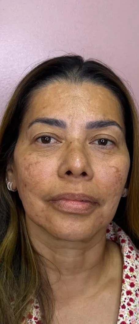 Harmonização facial: Frontal · terço inferior (depois)