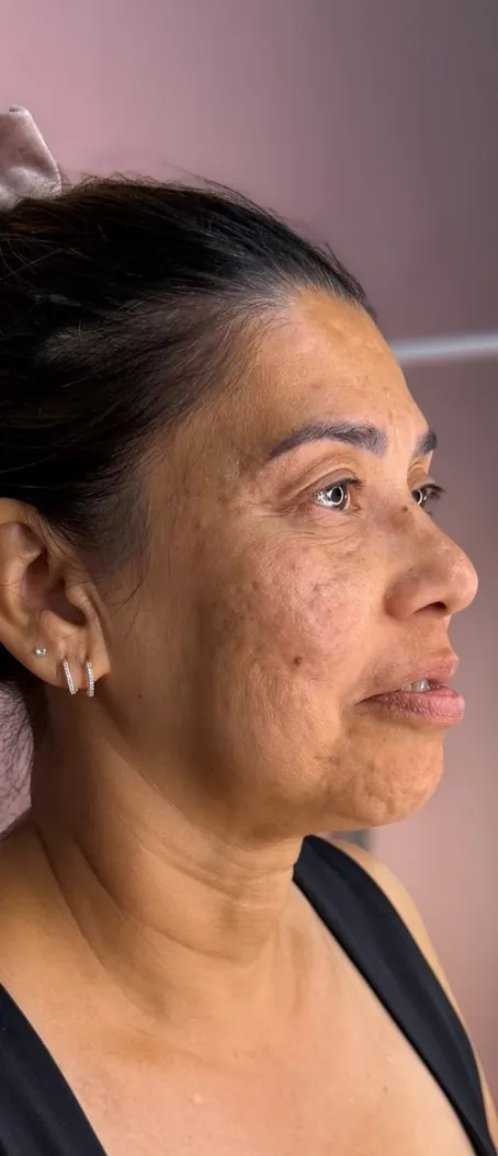 Harmonização facial: Perfil 90° · contorno inferior (antes)