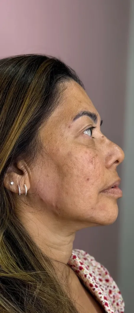 Harmonização facial: Perfil 90° · contorno inferior (depois)