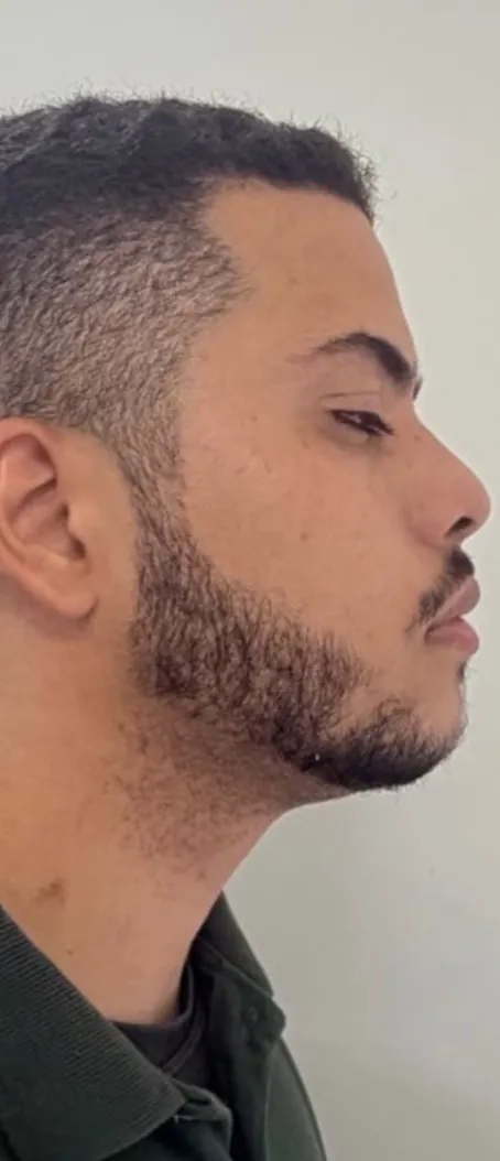 Harmonização masculina: Masculino · queixo e mandíbula (depois)