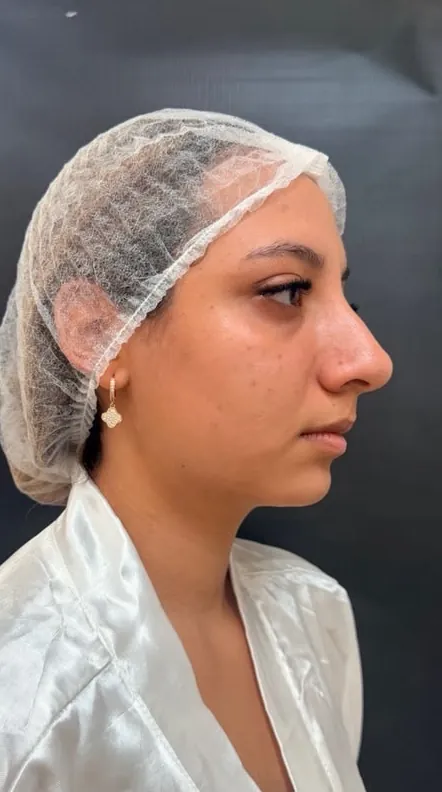 Harmonização facial: Perfil · mandíbula, mento e lábios (antes)