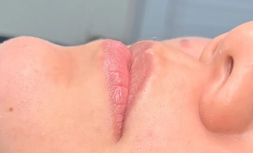 Preenchimento labial: Caso 01 · contorno e hidratação (antes)