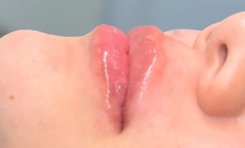 Preenchimento labial: Caso 01 · contorno e hidratação (depois)