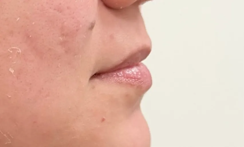 Preenchimento labial: Caso 02 · projeção sutil (antes)
