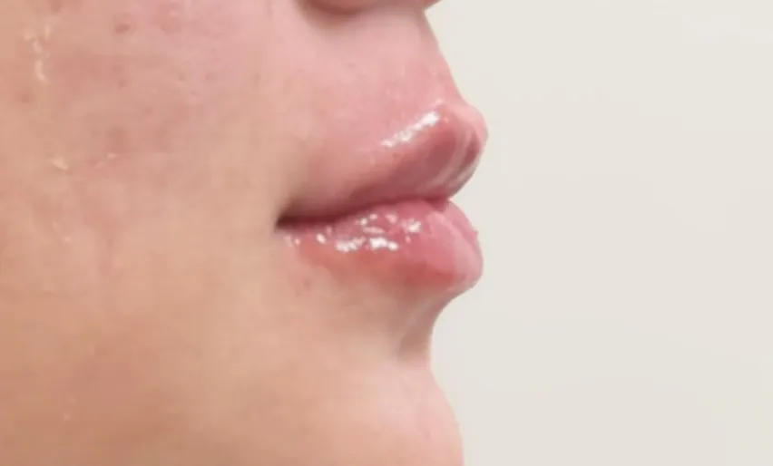 Preenchimento labial: Caso 02 · projeção sutil (depois)