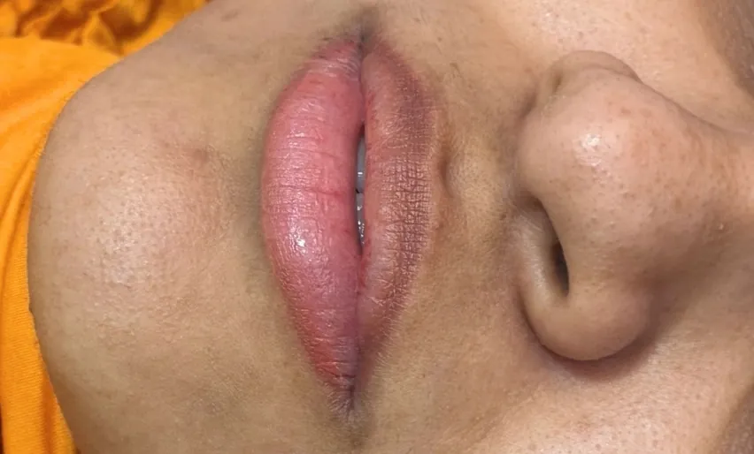 Preenchimento labial: Caso 03 · volume natural (antes)
