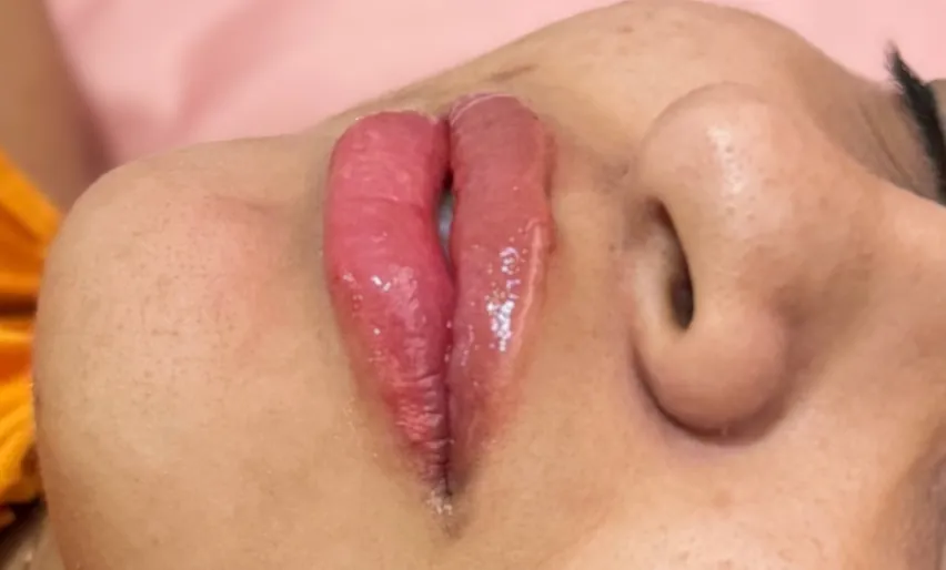 Preenchimento labial: Caso 03 · volume natural (depois)