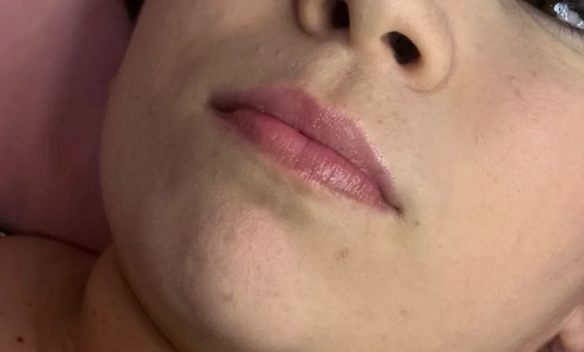 Preenchimento labial: Caso 06 · hidratação e volume (antes)