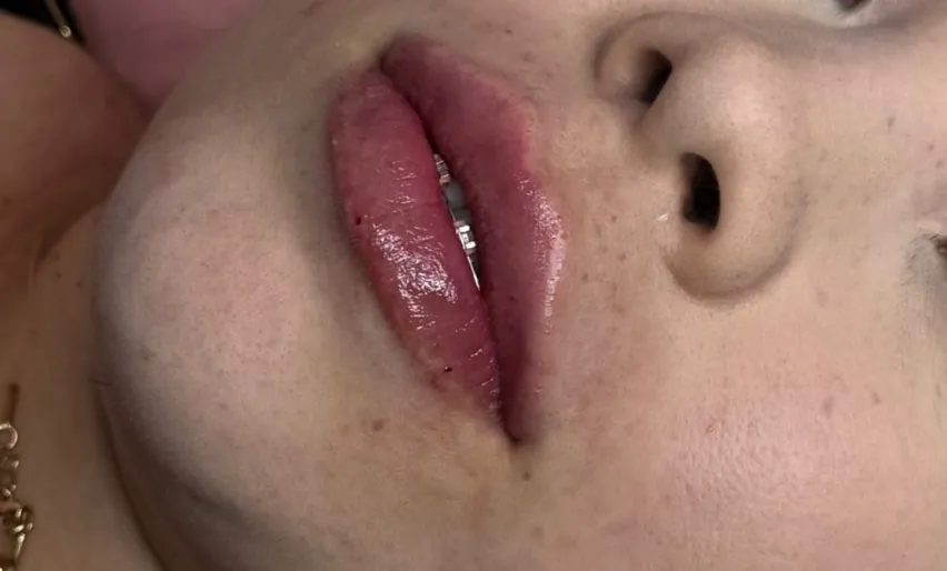 Preenchimento labial: Caso 06 · hidratação e volume (depois)