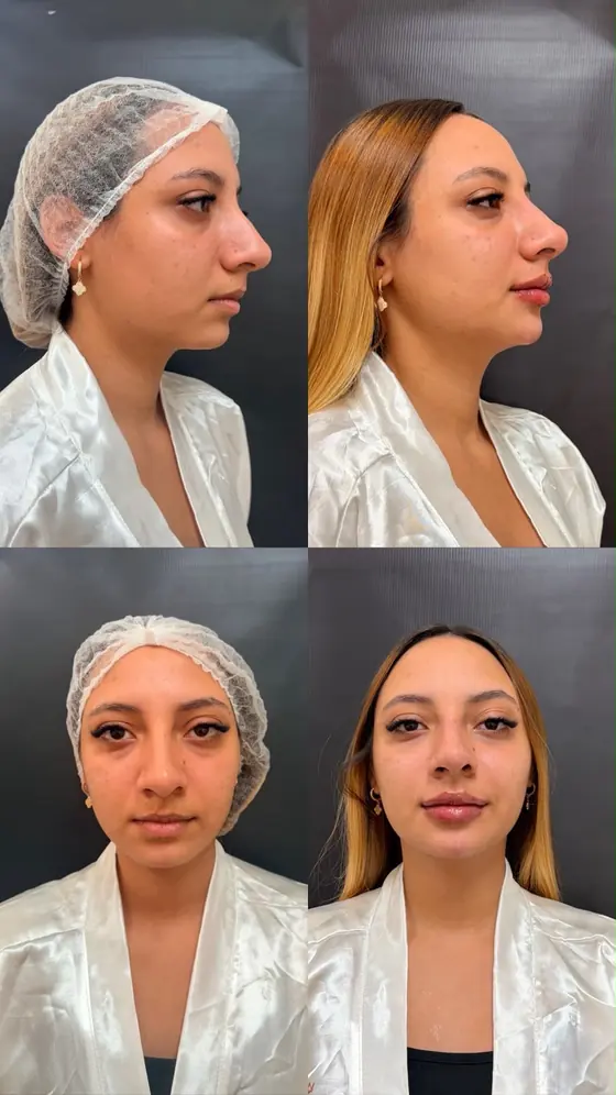 Harmonização facial: antes e depois, perfil e frontal