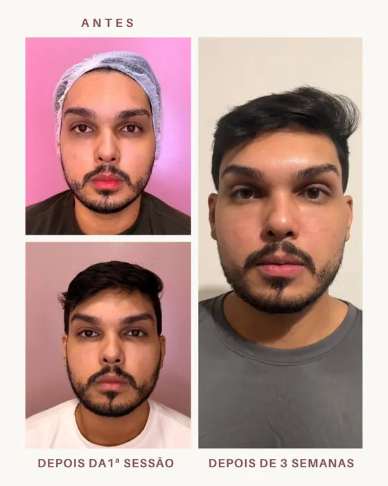 Ultrassom masculino: antes, depois da 1ª sessão e depois de 3 semanas
